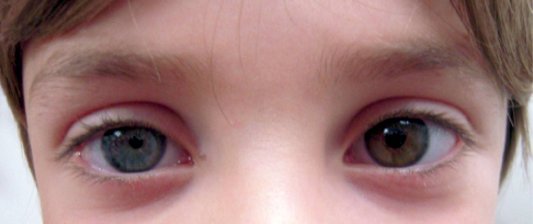 Зрачки разного размера у взрослого - причины анизокории глаз, почему, из-за чего