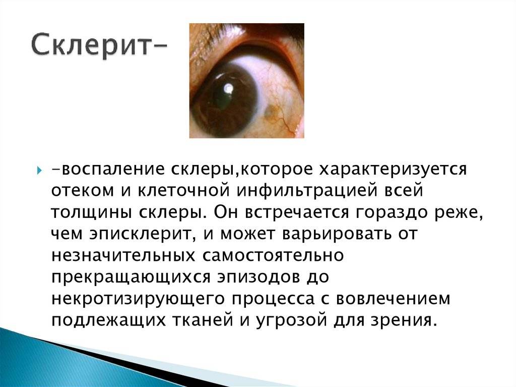 Эписклерит глаза – причины, симптомы и лечение (фото)
