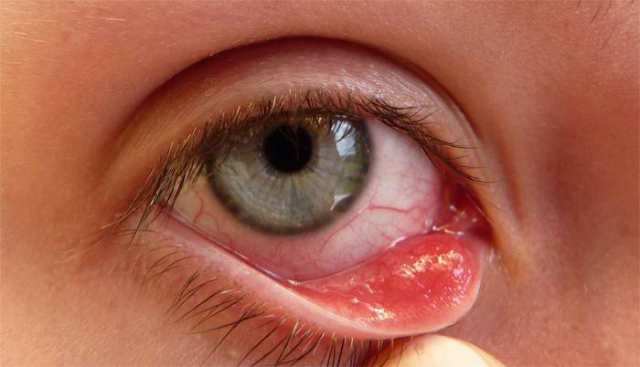 глазной симптом
